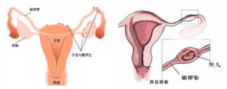 胎位不正